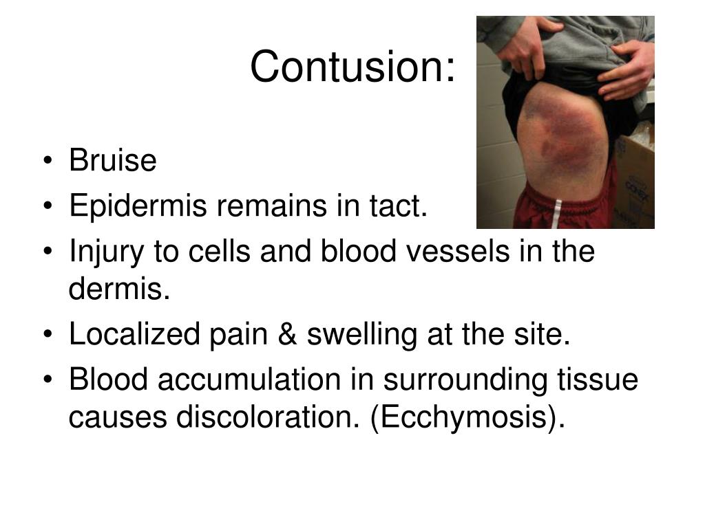 PPT Soft Tissue Injuries PowerPoint Presentation, free download ID2774501
