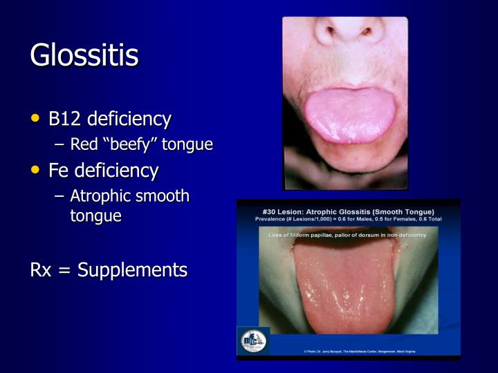 PPT Extra GI Manifestations of IBD PowerPoint Presentation ID2777829