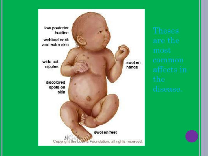 PPT Turner Syndrome PowerPoint Presentation ID2876758