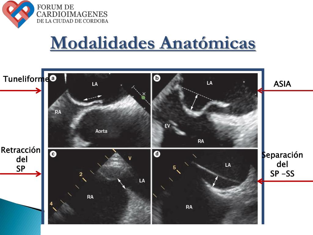 PPT FORAMEN OVAL PERMEABLE PowerPoint Presentation, free download