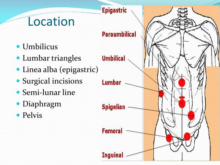 PPT hernia PowerPoint Presentation ID2957512