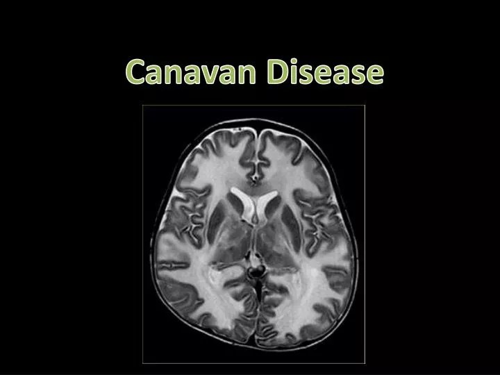 PPT Canavan Disease PowerPoint Presentation, free download ID2960692