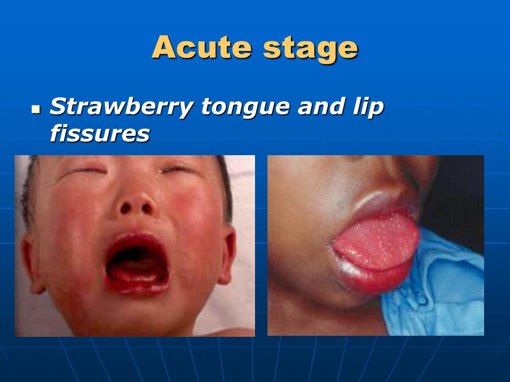 PPT Kawasaki Disease PowerPoint Presentation, free download ID2961600