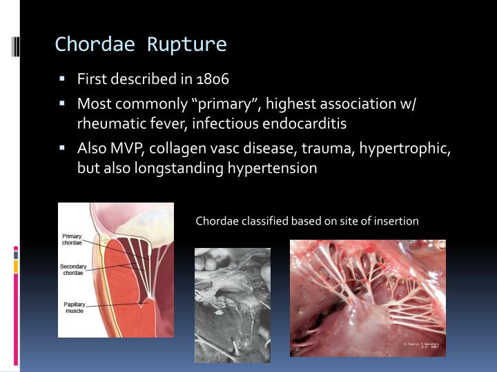 PPT CHORDAE TENDINeAE RUPTURE PowerPoint Presentation ID2970459
