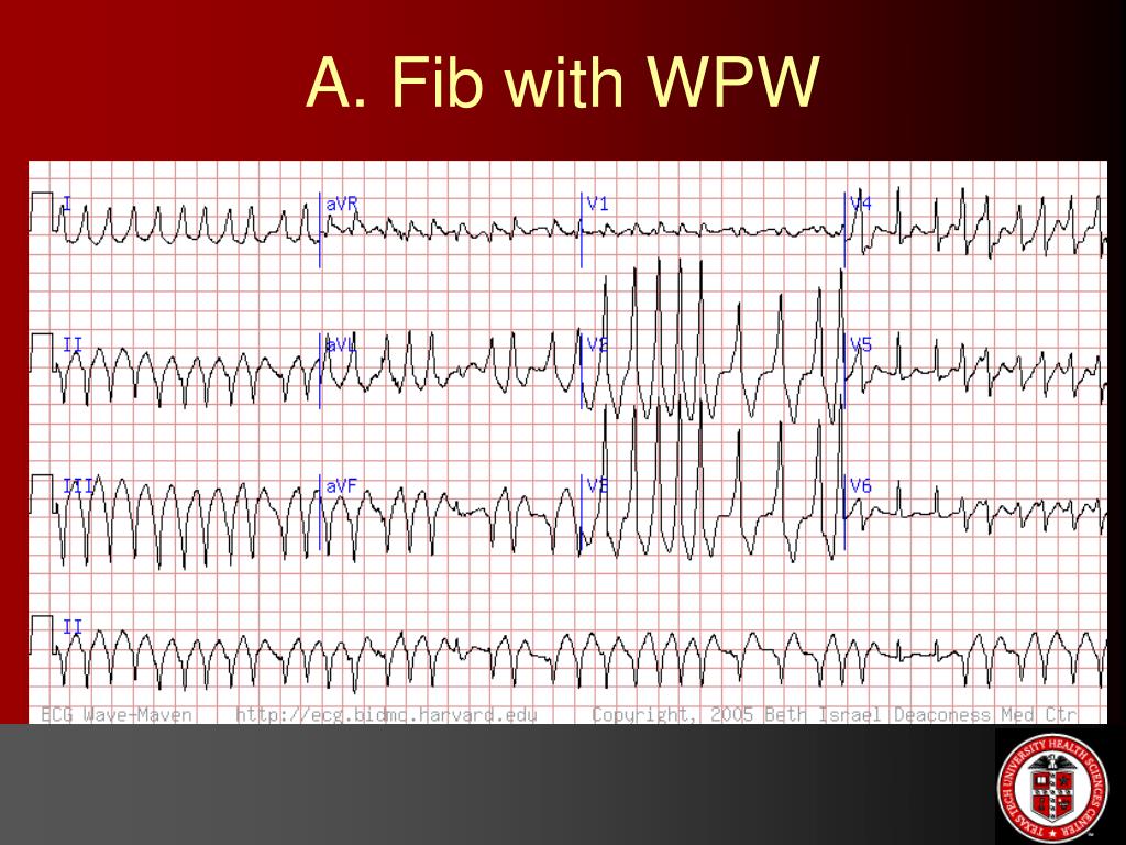PPT ECG etc… (Miscellaneous ECGs) PowerPoint Presentation, free