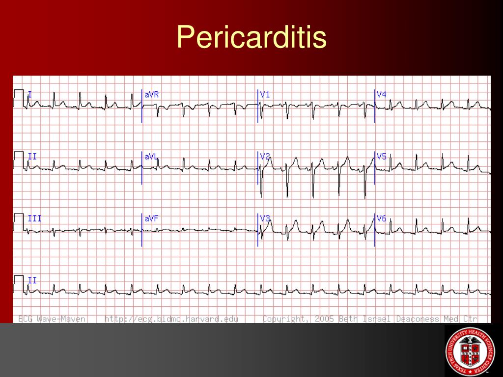 PPT ECG etc… (Miscellaneous ECGs) PowerPoint