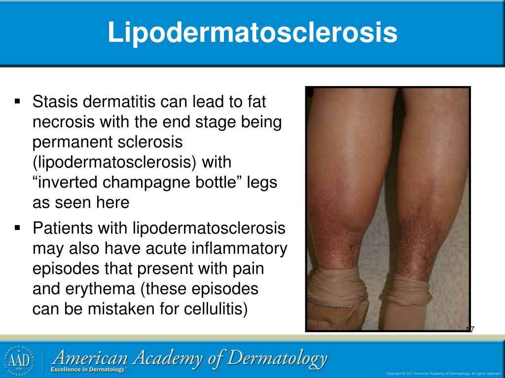 PPT Stasis Dermatitis and Leg Ulcers PowerPoint Presentation, free
