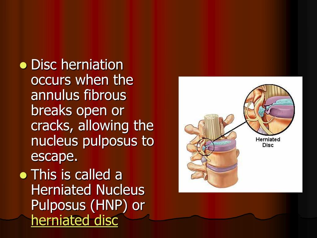 PPT Lumbar disc herniation PowerPoint Presentation, free download ID2992675