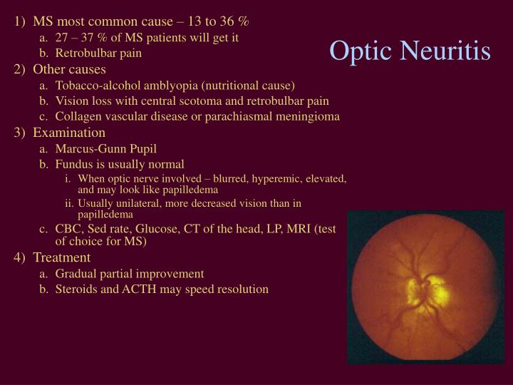 PPT Acute Vision Loss PowerPoint Presentation ID3000924