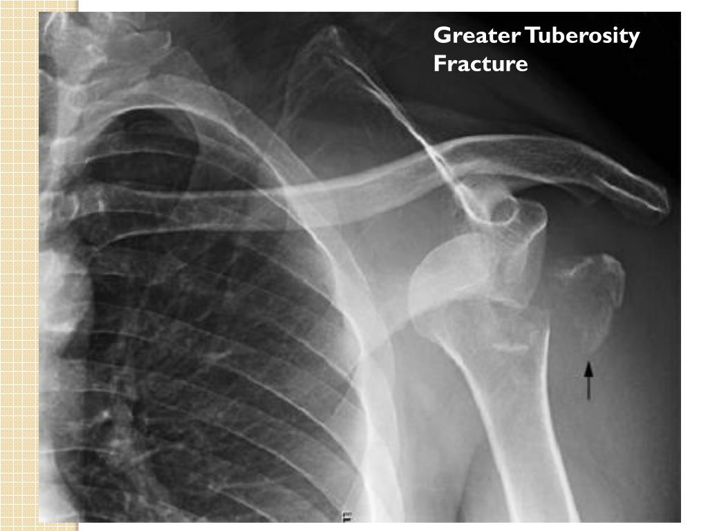 PPT Radiography of the Shoulder PowerPoint Presentation, free