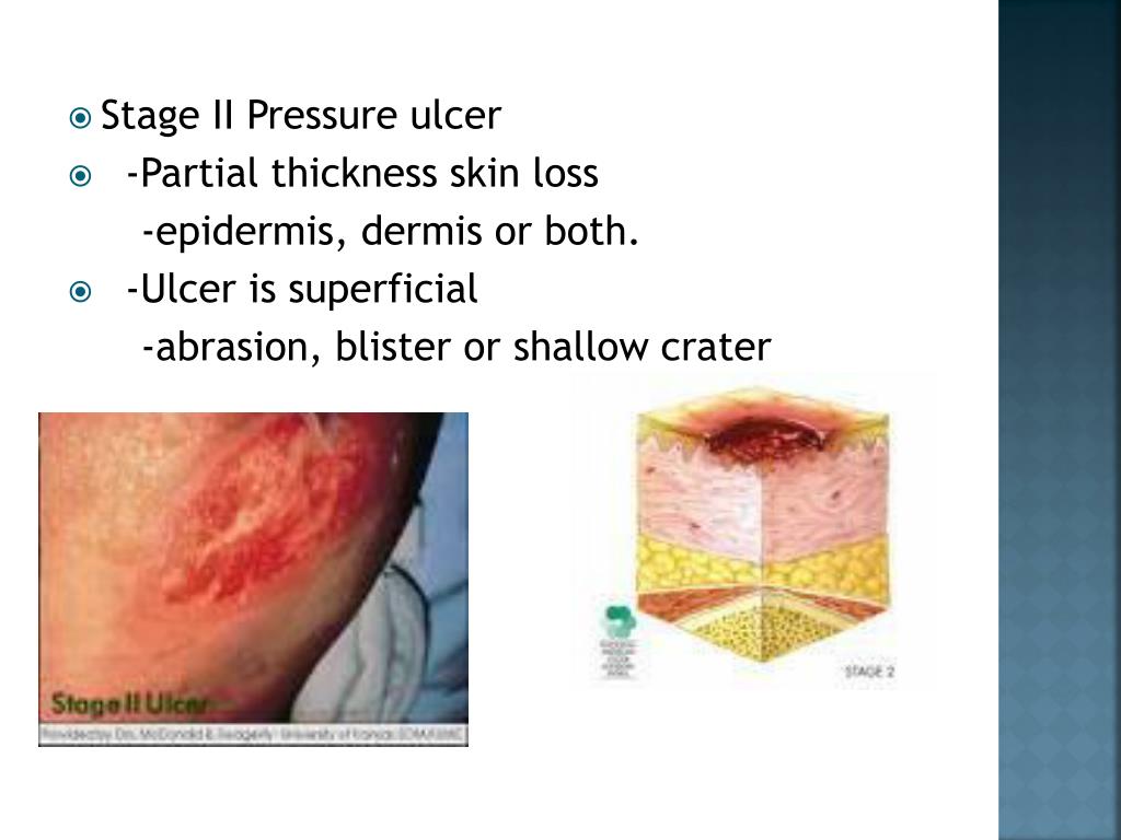 PPT Venous and pressure ulcers PowerPoint Presentation, free download