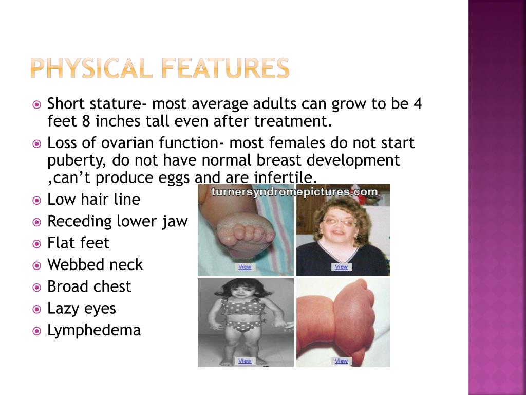 PPT Turner Syndrome PowerPoint Presentation, free download ID3066020