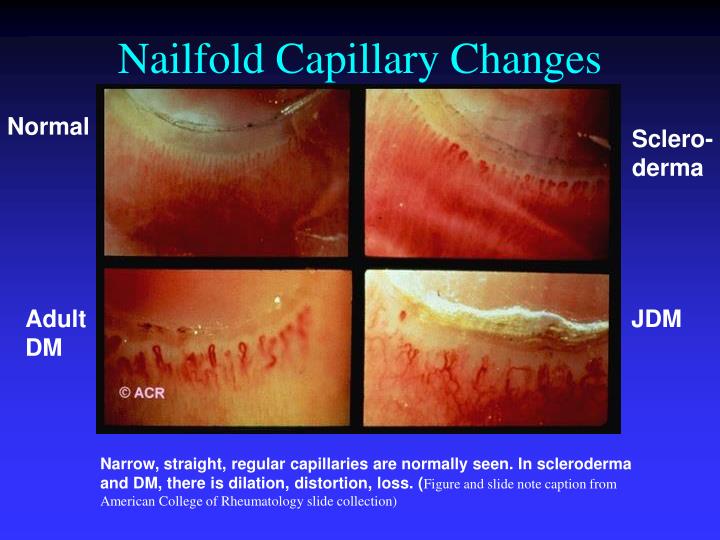 PPT Dermatomyositis Muscle Histology PowerPoint Presentation ID