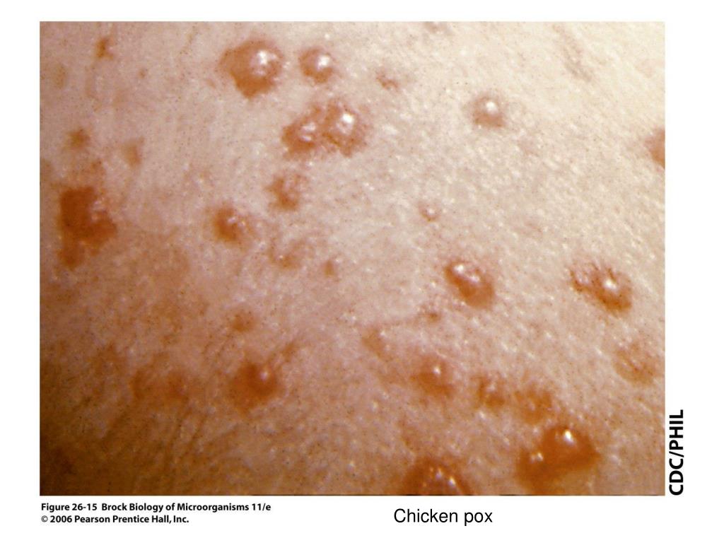 PPT Staphylococcus aureus Boils Walled off from body with fibrin PowerPoint Presentation