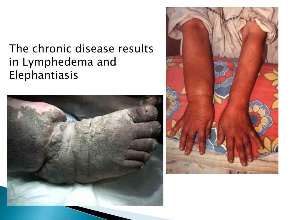 PPT Lymphatic filariasis PowerPoint Presentation, free download ID