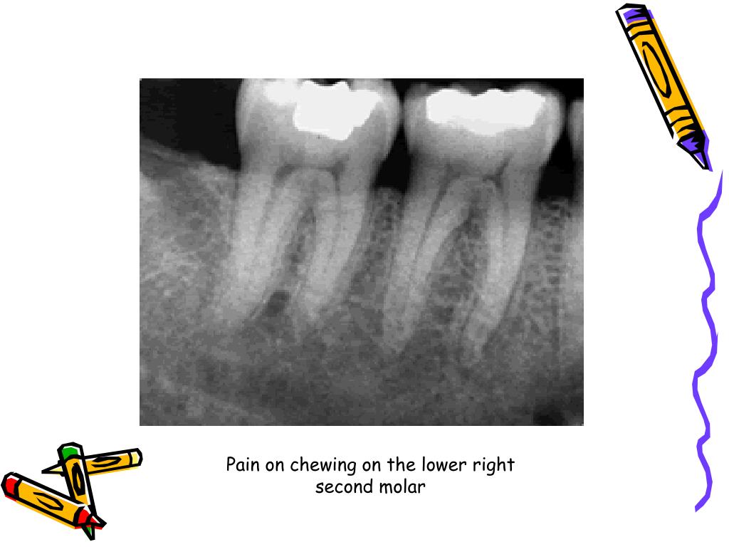 PPT Endodontic diagnosis and treatment planning PowerPoint