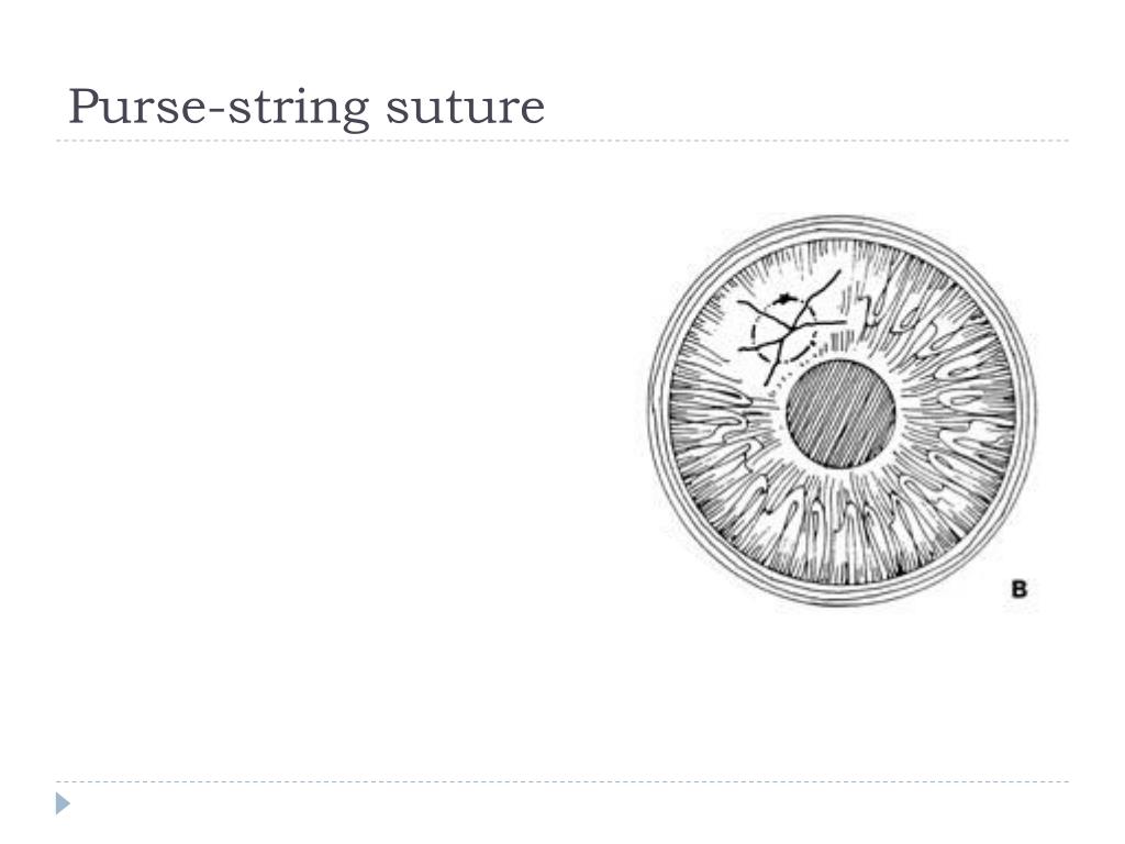 PPT Corneal laceration PowerPoint Presentation, free download ID