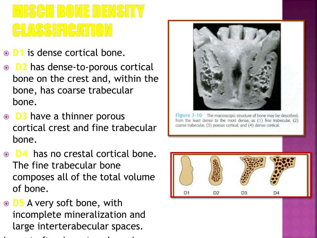 PPT Bone Density A Key Determinant for Treatment Planning