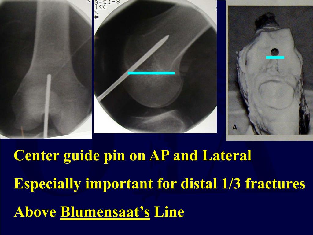 PPT Femoral Shaft Fractures PowerPoint Presentation, free download