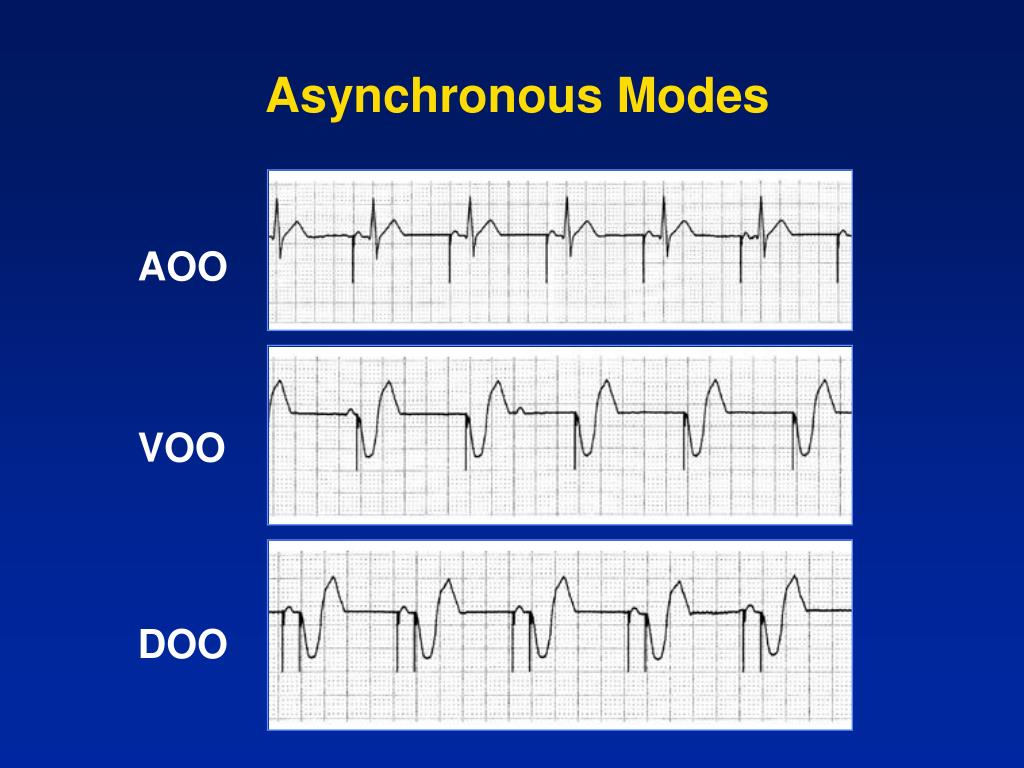 PPT Dual Chamber Temporary Pacing Operations & Troubleshooting