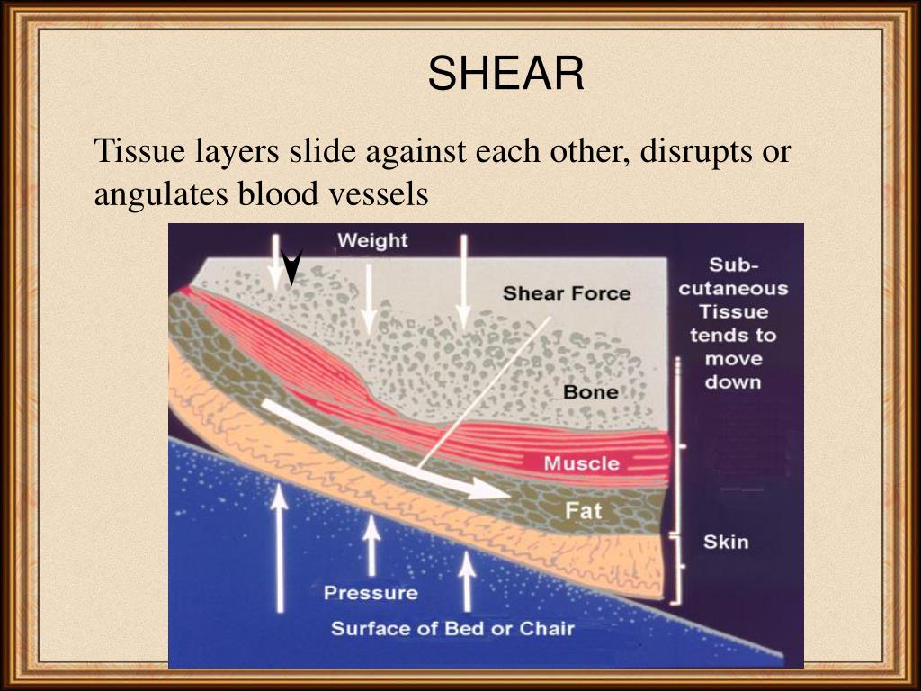 PPT Pressure Ulcers Putting Pressure on Prevention Karen Clay, RN