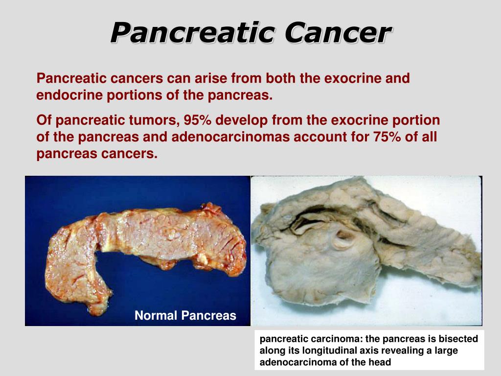 PPT Pancreatic Cancer PowerPoint Presentation, free download ID3295800
