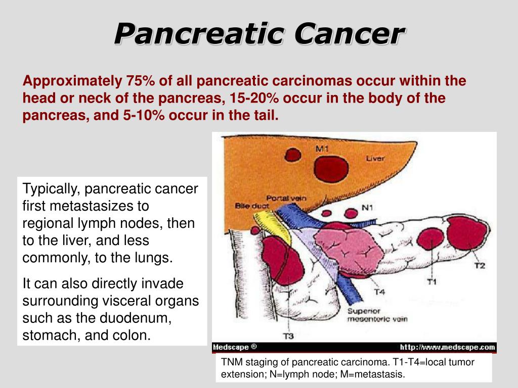 PPT Pancreatic Cancer PowerPoint Presentation, free download ID3295800