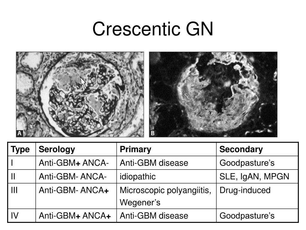 PPT Glomerulonephritis in children PowerPoint Presentation, free
