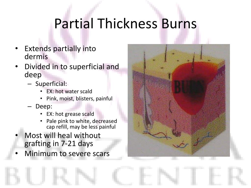 PPT Burns in the Emergency Department PowerPoint Presentation, free