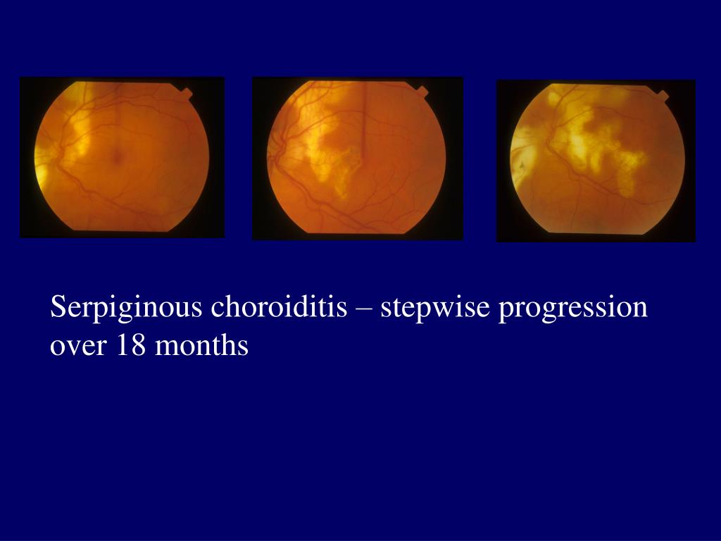 PPT Euretina Meeting 2013 Hamburg Miles Stanford Medical Eye Unit St Thomas’ Hospital London
