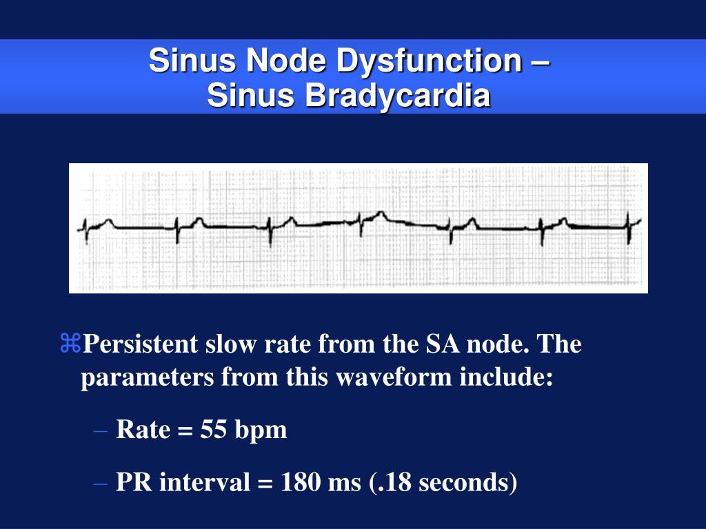 PPT Indications for permanent pace maker implantation PowerPoint