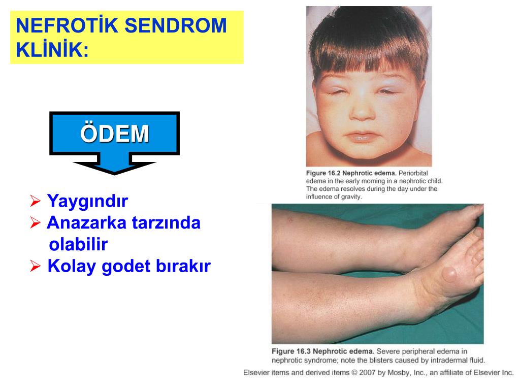 PPT PROTEİNÜRİ VE NEFROTİK SENDROM PowerPoint Presentation, free