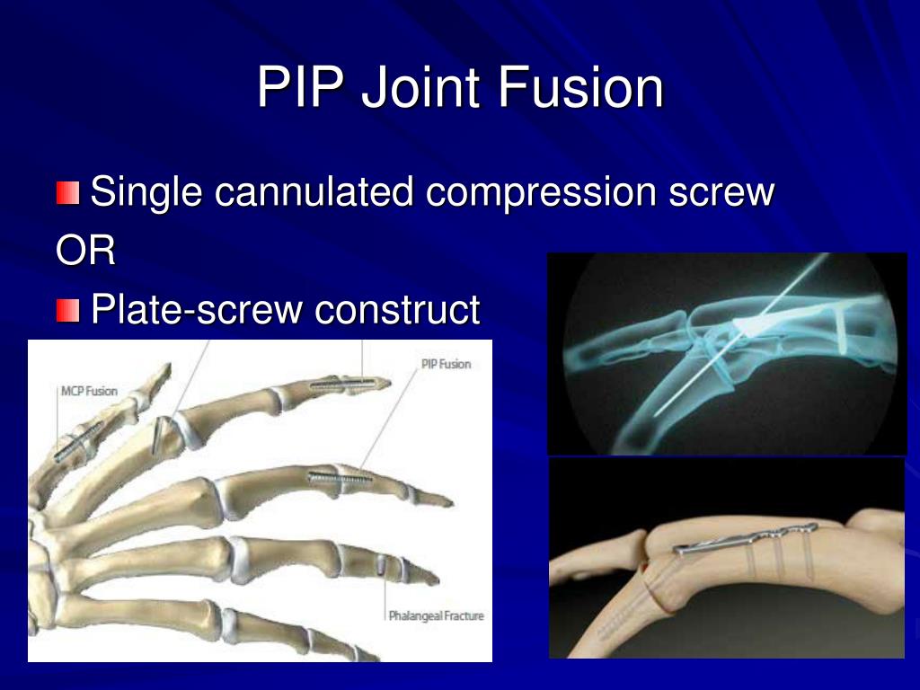 PPT Hand and Wrist Arthritis PowerPoint Presentation, free download