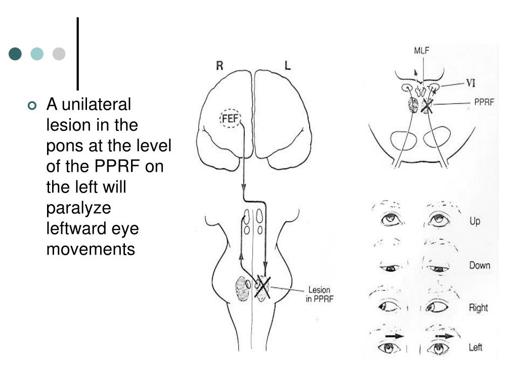 PPT Eye movement disorder PowerPoint Presentation, free download ID3336024