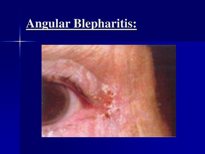 PPT Posterior Blepharitis PowerPoint Presentation ID3336265