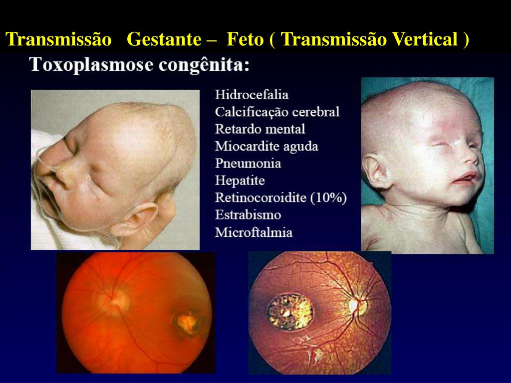 PPT Toxoplasmose e H I V PowerPoint Presentation ID3348087
