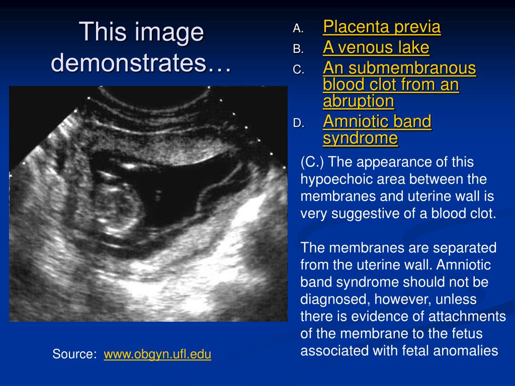 PPT Placental US PowerPoint Presentation, free download ID3356735