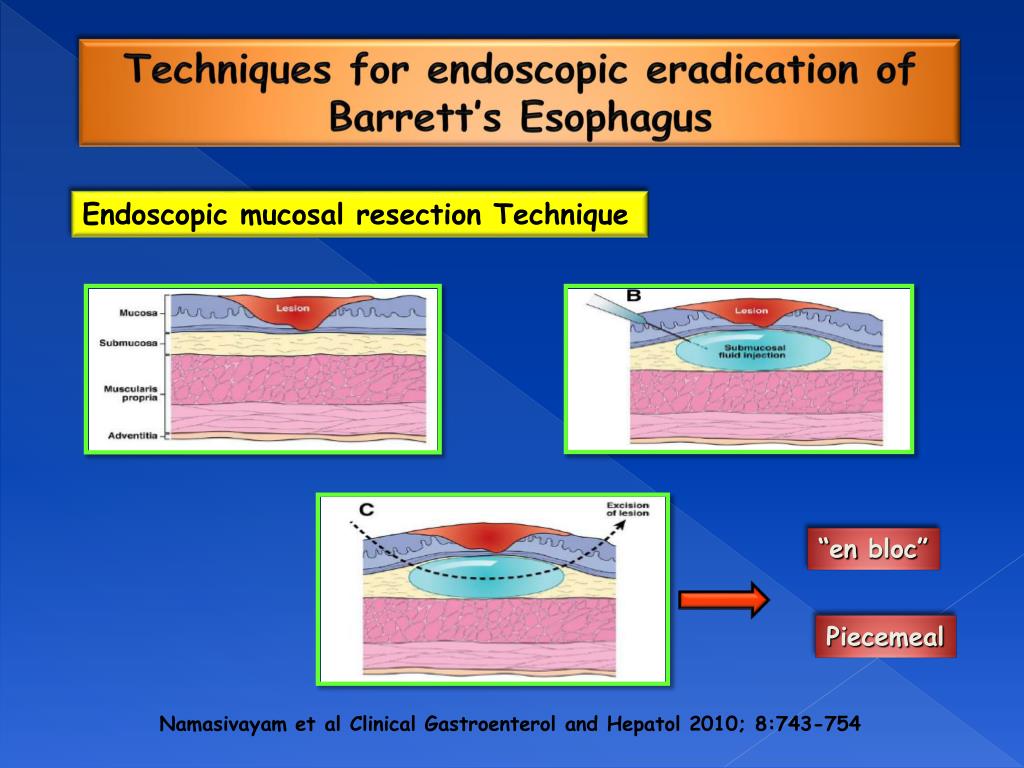PPT Endoscopic mucosal resection vs radiofrequency ablation in