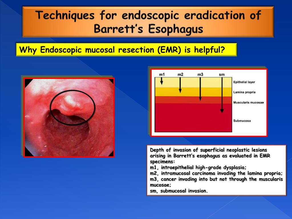 PPT Endoscopic mucosal resection vs radiofrequency ablation in