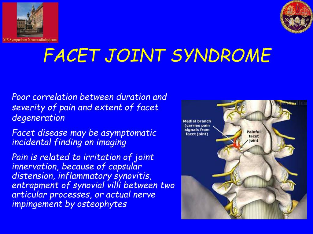 PPT PERCUTANEOUS RF NEUROTOMY IS EFFECTIVE IN THE TREATMENT OF FACET