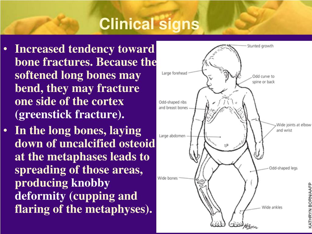 PPT Rickets Etiology, pathogenesis, clinical features, diagnostics
