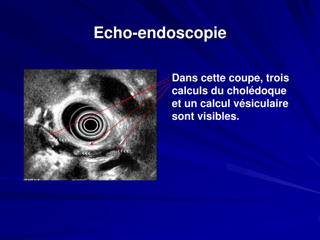 PPT PANCREATITES AIGUES PowerPoint Presentation ID3376702