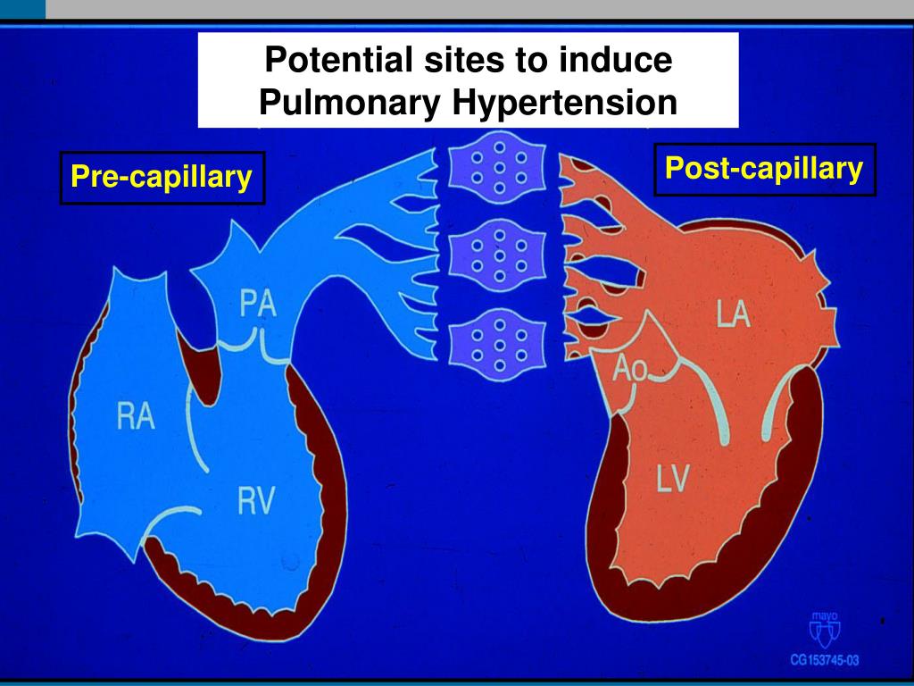 PPT Pulmonary Hypertension Management Update PowerPoint Presentation