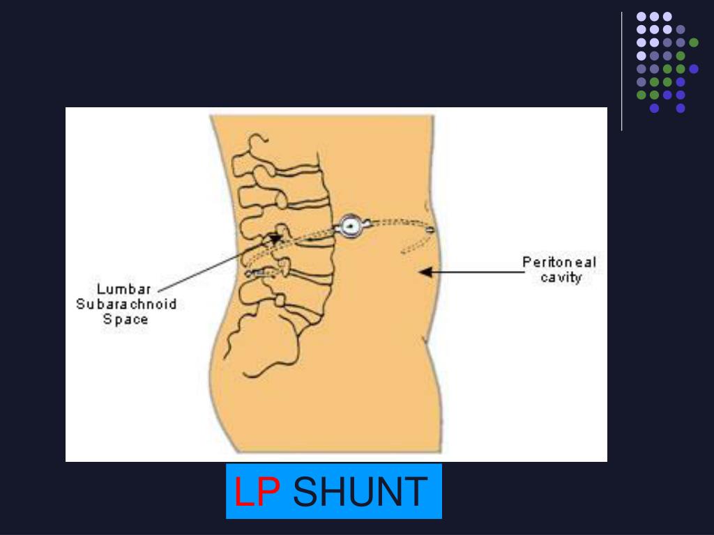 PPT VP Shunts PowerPoint Presentation, free download ID3387790