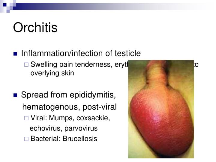 PPT Urolithiasis. Syndrome of swollen scrotum. PowerPoint