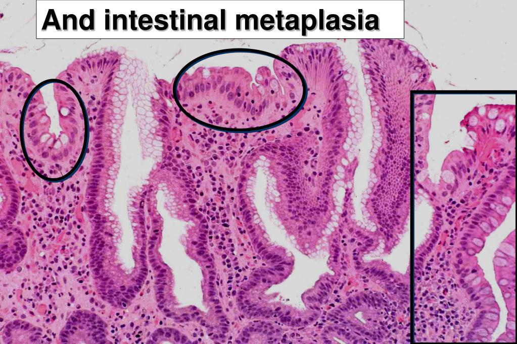 PPT Atrophic gastritides PowerPoint Presentation, free download ID