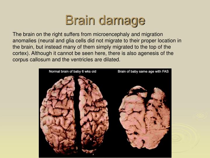 PPT Fetal Alcohol Syndrome Manish Saran MD Department of Psychiatry