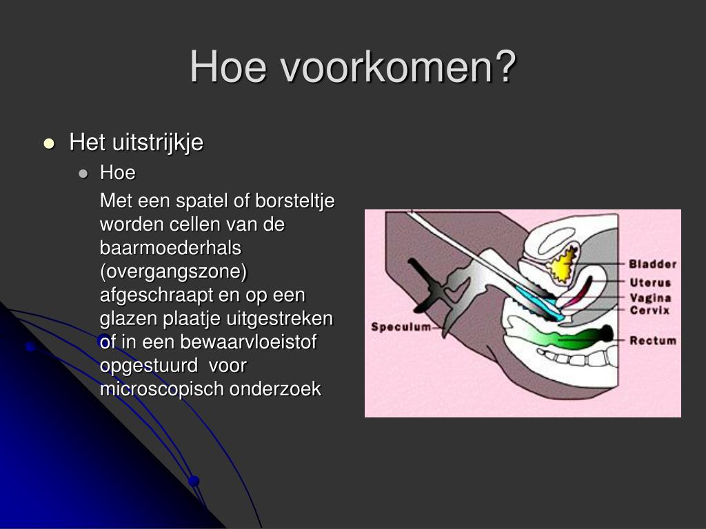 Baarmoederhalskanker: behandeling UMCG