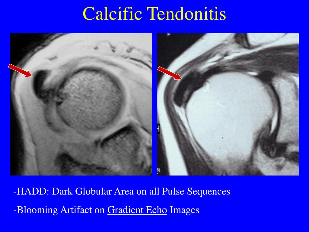 PPT MR Imaging of the Rotator Cuff PowerPoint Presentation, free download ID3407771