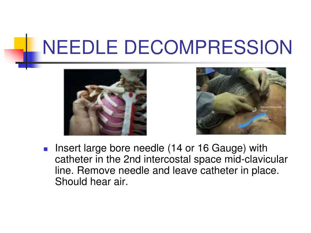 PPT CHEST PAIN PowerPoint Presentation, free download ID3412247